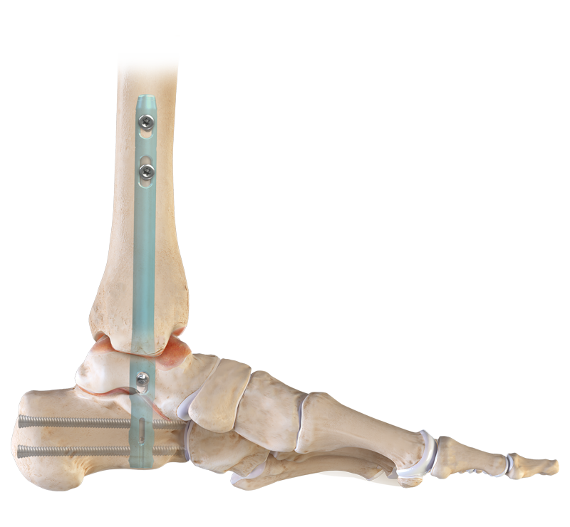 Arthrex - Guidewire with Trocar Tip, .092